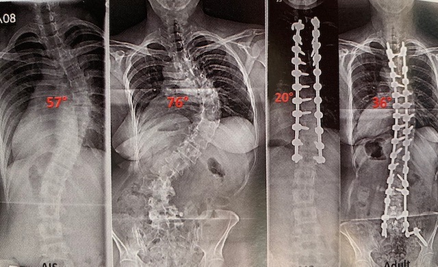 Local teens given another option to treat their scoliosis, Lifestyle