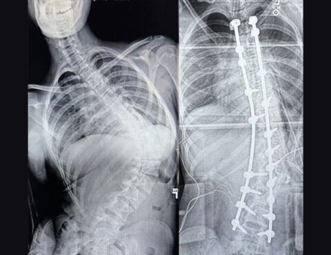 Corrective Spinal Surgery Transforms Life of Teen With Scoliosis and Cerebral Palsy