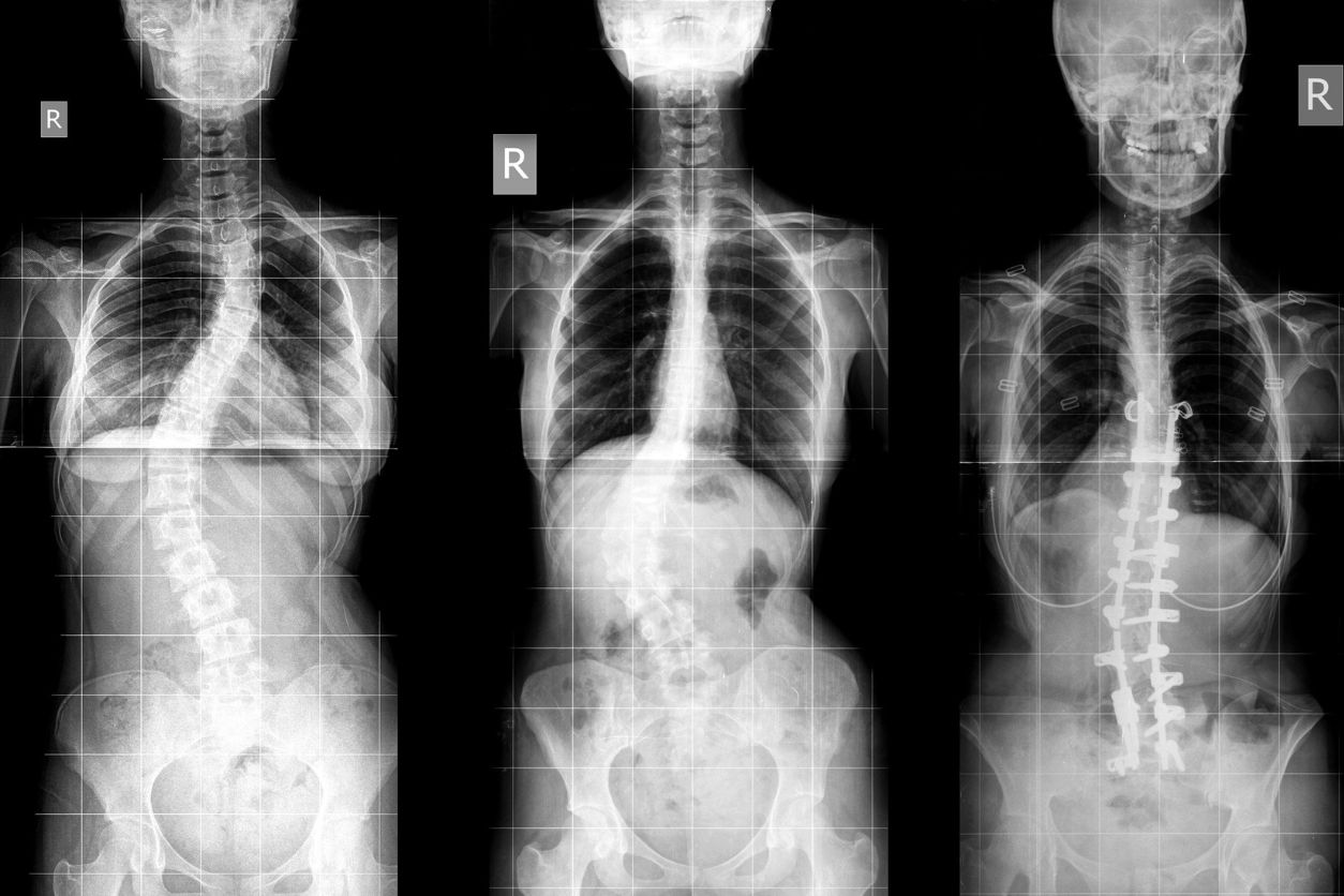 Cobb Angle Scoliosis Measurement: What It Means and Why It Matters